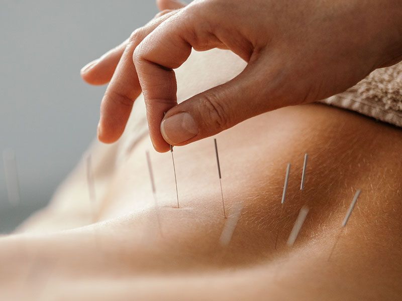 Cupping for inflammation